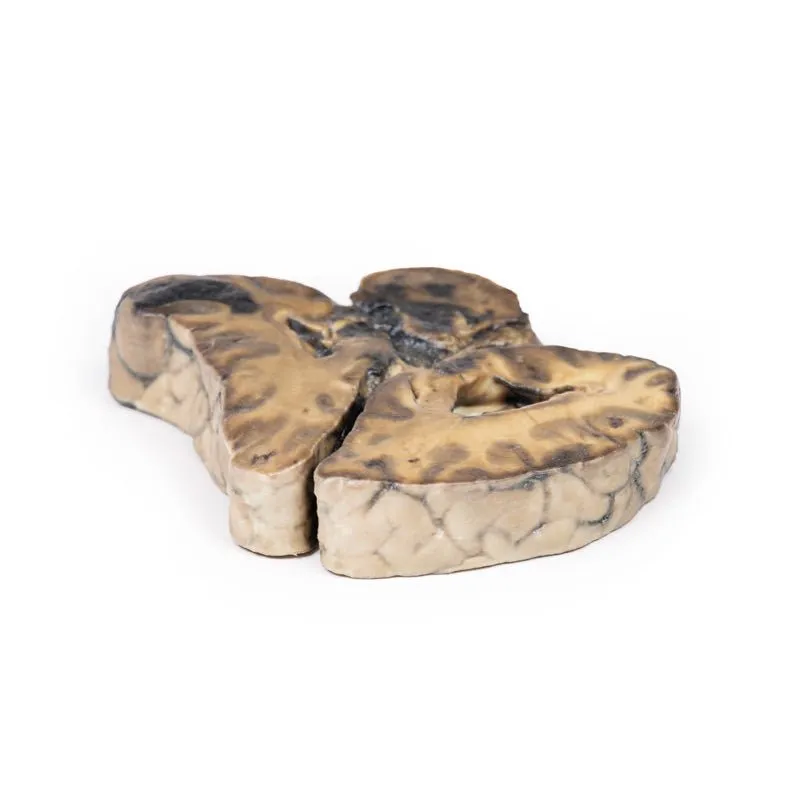 3D Printed Intracranial Space-Occupying Lesion