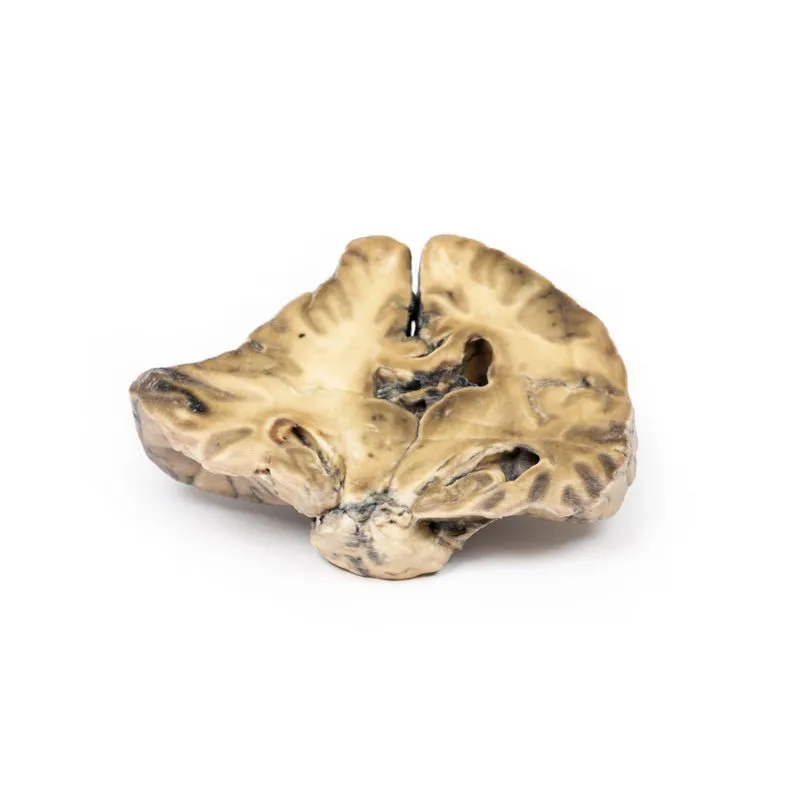 3D Printed Intracranial Space-Occupying Lesion